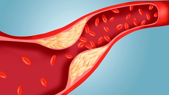 Chất béo Cholesterol đóng thành mảng trên thành mạch máu